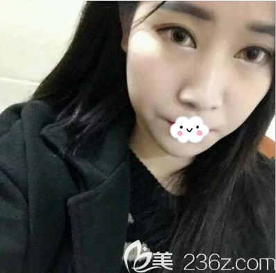 玻尿酸填充法令紋術(shù)后即刻效果