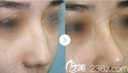 韓國艾恩鼻綜合手術(shù)案例 韓國艾恩鼻綜合手術(shù)案例