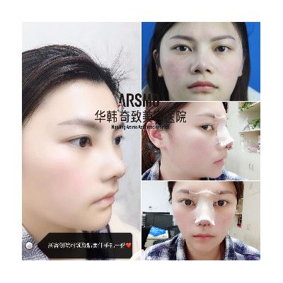 裴柄萬院長(zhǎng)鼻整形案例 裴柄萬院長(zhǎng)鼻整形案例