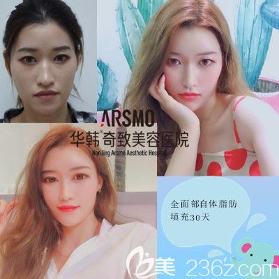 方章碩自體脂肪面部填充案例 方章碩自體脂肪面部填充案例