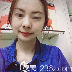 28歲就開始出現(xiàn)面部下垂鼻唇溝明顯到徐州時光洪揚做了線雕抗衰中的佼佼者——翊品線，分享術(shù)后蛻變