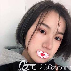 王亞勇醫(yī)生為我注射玻尿酸填充面部術(shù)后3天面部微腫