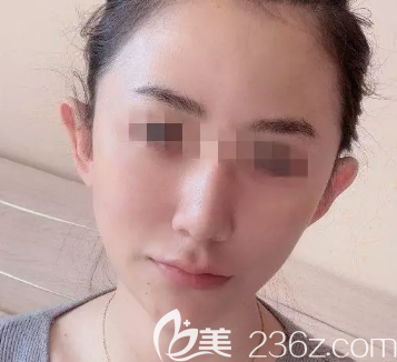 面部自體脂肪膠術(shù)后兩個月 面部自體脂肪膠術(shù)后兩個月