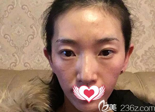 在<!--<i data=20240703-sp></i>-->美萊做自體脂肪填充淚溝手術(shù)前 在<!--<i data=20240703-sp></i>-->美萊做自體脂肪填充淚溝手術(shù)前