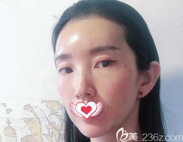 自體脂肪填充淚溝第7天填充部位明顯飽滿了很多 自體脂肪填充淚溝第7天填充部位明顯飽滿了很多