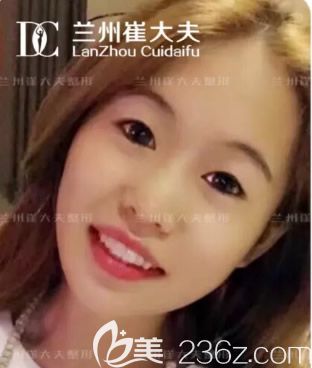 蘭州崔大夫整形徐隴豫割雙眼前 蘭州崔大夫整形徐隴豫割雙眼前