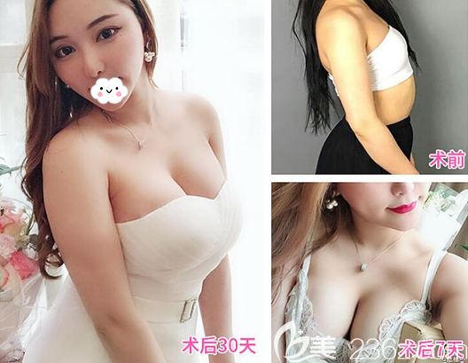 成都銅雀臺雷剛假體豐胸術(shù)后30天恢復(fù)圖