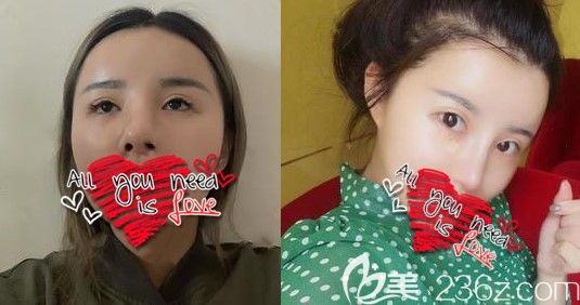 長春中妍劉曉吉隆鼻案例效果圖 長春中妍劉曉吉隆鼻案例效果圖