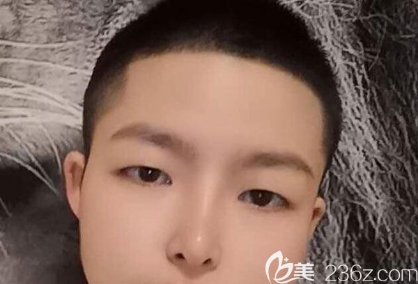 找昆明夢想整形做硅膠假體隆鼻三個月后大變樣，真正讓你見證男生隆鼻有多帥