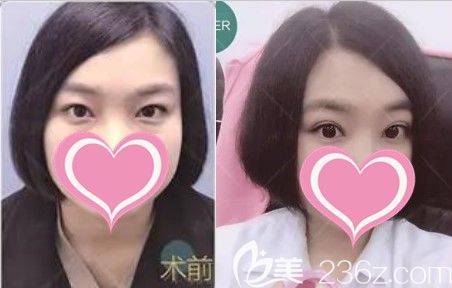 長春中妍劉曉吉醫(yī)生失敗雙眼皮修復(fù)案例 長春中妍劉曉吉醫(yī)生失敗雙眼皮修復(fù)案例