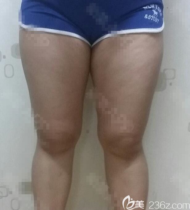 術(shù)前 術(shù)前