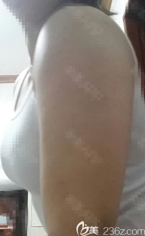 手臂吸脂 手臂吸脂