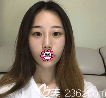 在北京新星靚做手術(shù)前 在北京新星靚做手術(shù)前