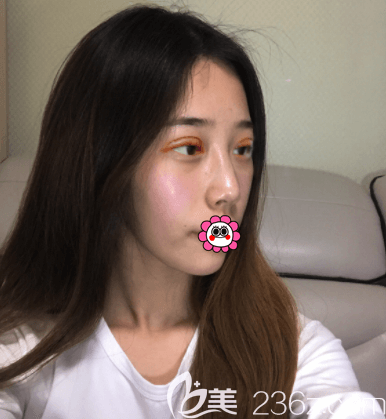 醫(yī)生給我做美眸成形術(shù)第3天 醫(yī)生給我做美眸成形術(shù)第3天