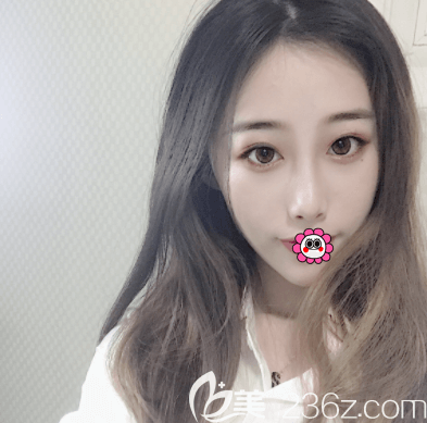 在北京新星靚做美眸成形術(shù)一個半月樣子 在北京新星靚做美眸成形術(shù)一個半月樣子