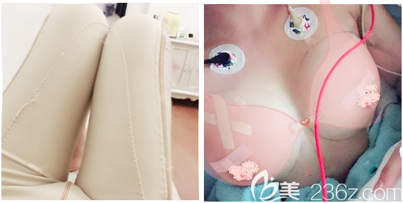 自體脂肪脂肪豐胸和大腿吸脂術(shù)后即刻效果圖