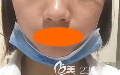 我去<!--<i data=20240703-sp></i>-->美容醫(yī)院找周玲做微針祛痘+縮小毛孔術(shù)后第6天