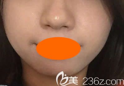 我去<!--<i data=20240703-sp></i>-->美容醫(yī)院找周玲做微針祛痘術(shù)后第25天效果