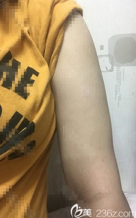 手臂吸脂術(shù)后一個(gè)月 手臂吸脂術(shù)后一個(gè)月