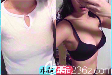 成都西區(qū)醫(yī)院鄧東偉假體豐胸術(shù)后對比圖