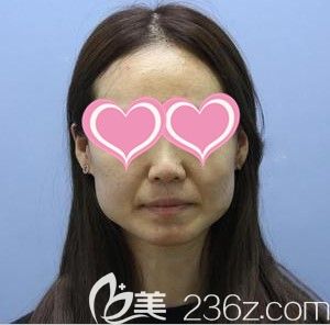 我填充法令紋和去咬肌的術(shù)前照 我填充法令紋和去咬肌的術(shù)前照