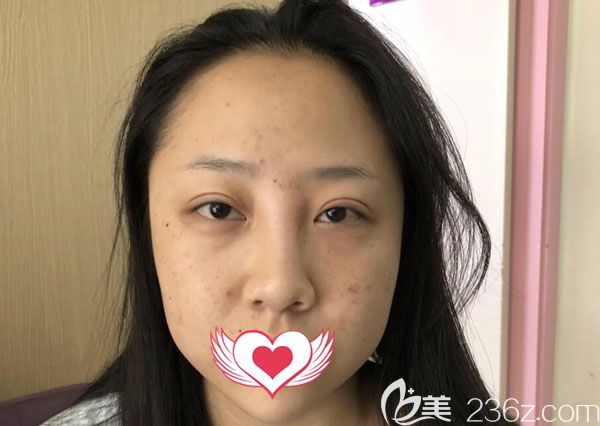 在<!--<i data=20240703-sp></i>-->美萊做鼻修復(fù)手術(shù)前 在<!--<i data=20240703-sp></i>-->美萊做鼻修復(fù)手術(shù)前