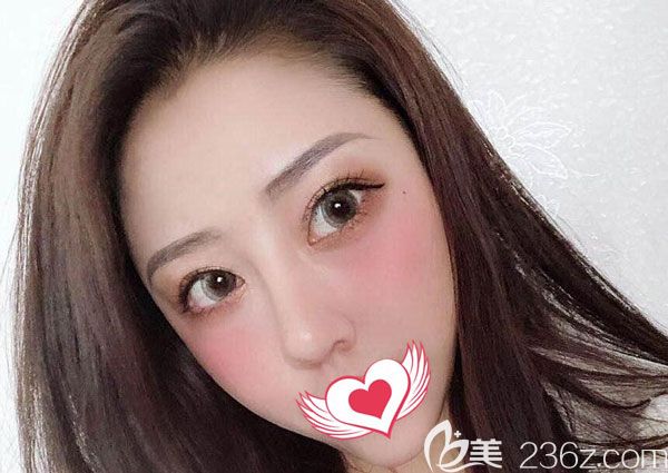 得知在美萊坐診，慕名找他做了肋軟骨鼻綜合修復(fù)手術(shù)，效果杠杠的