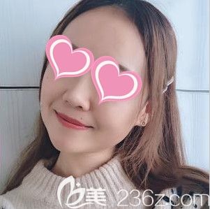 長春中妍做完瘦臉去咬肌的術(shù)后照 長春中妍做完瘦臉去咬肌的術(shù)后照