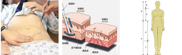 廣州美萊鄧勁松吸脂手術(shù)過程圖