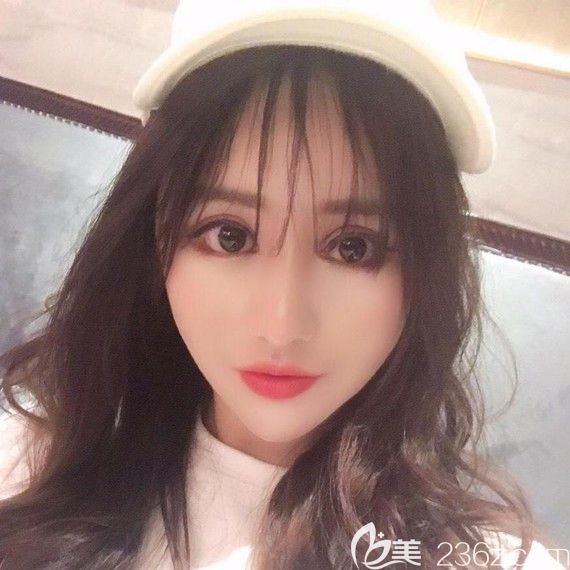 韓國(guó)綺林整形醫(yī)院面部輪廓術(shù)價(jià)格優(yōu)惠,做了顴骨顴弓+去下頜角+Vline下巴整形恢復(fù)圖