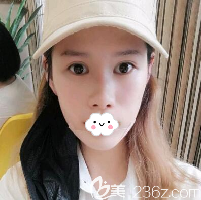 假體墊下巴術后第二天恢復照片