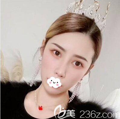 在成都市區(qū)西區(qū)醫(yī)院找鄧東偉做了假體隆下巴以后，下我巴短小的顏值硬傷終于被改善了