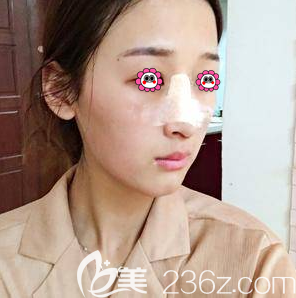 連凱峰醫(yī)生給我做硅膠假體隆鼻第4天樣子 連凱峰醫(yī)生給我做硅膠假體隆鼻第4天樣子