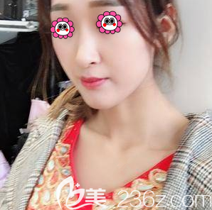 北京假體隆鼻醫(yī)院排名好的北京藝星硅膠假體隆鼻案例 北京假體隆鼻醫(yī)院排名好的北京藝星硅膠假體隆鼻案例