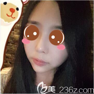 整友必看：國(guó)內(nèi)做的自體脂肪面部填充+隆鼻價(jià)格不貴效果一點(diǎn)也不比韓國(guó)差