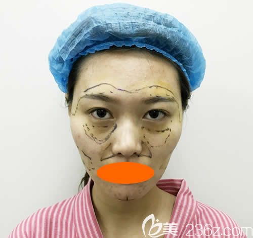 去西寧時(shí)光找祁永章醫(yī)生做大腿抽脂+自體脂肪全臉填充時(shí)臉部設(shè)計(jì)劃線照片