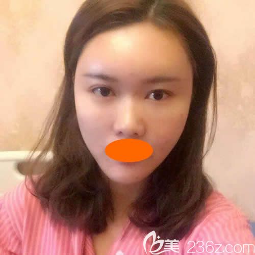 去西寧時(shí)光找祁永章醫(yī)生做大腿抽脂+自體脂肪全臉填充時(shí)臉部術(shù)后第18天<span style=