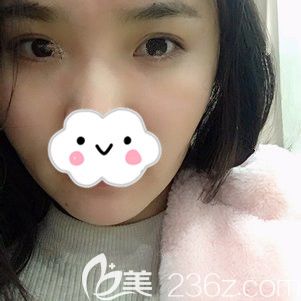 剛做完自體脂肪填充太陽穴術后效果