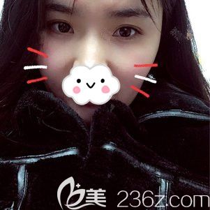 自體脂肪填充太陽穴術后20天效果