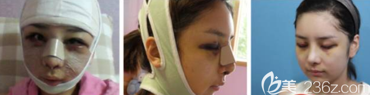 手術(shù)當(dāng)天