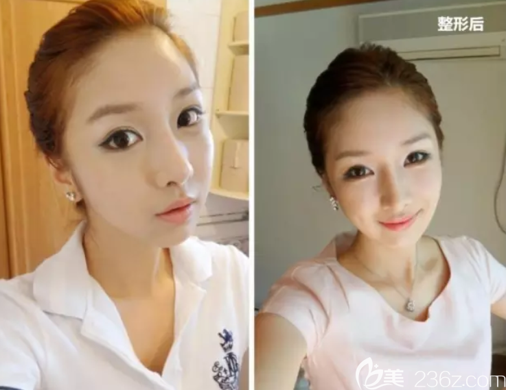 其實(shí)不丑卻又在韓國(guó)高蘭得做了隆鼻顴骨縮小下頜角縮小，我只是想美的更精致