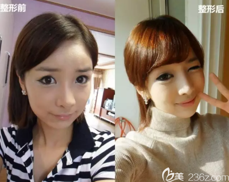 韓國高蘭得顴骨縮小真人案例