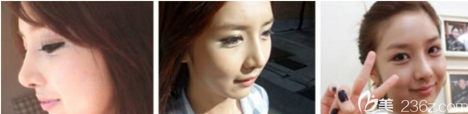 術(shù)后一個月