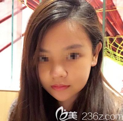 在韓國(guó)博朗溫做鼻綜合手術(shù)后第7天