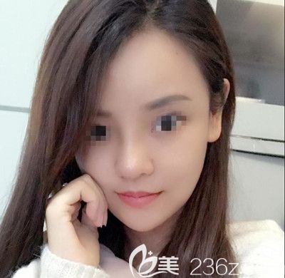 在韓國(guó)博朗溫做鼻綜合手術(shù)后第11天