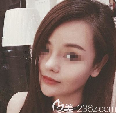 在韓國(guó)博朗溫做鼻綜合手術(shù)后第20天