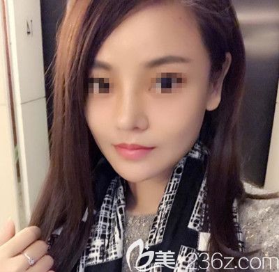 在韓國(guó)博朗溫做鼻綜合手術(shù)后第1個(gè)月