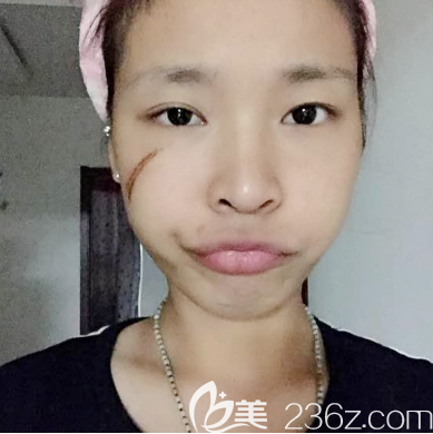 呂美琪醫(yī)生面部凹陷性疤痕治療一周效果圖