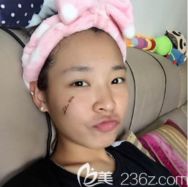 去深圳鵬程疤痕科治療疤痕九天開始脫痂