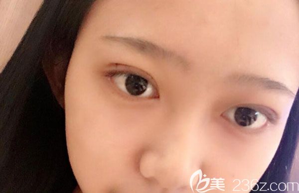 全切雙眼皮第7天傷口已經(jīng)愈合